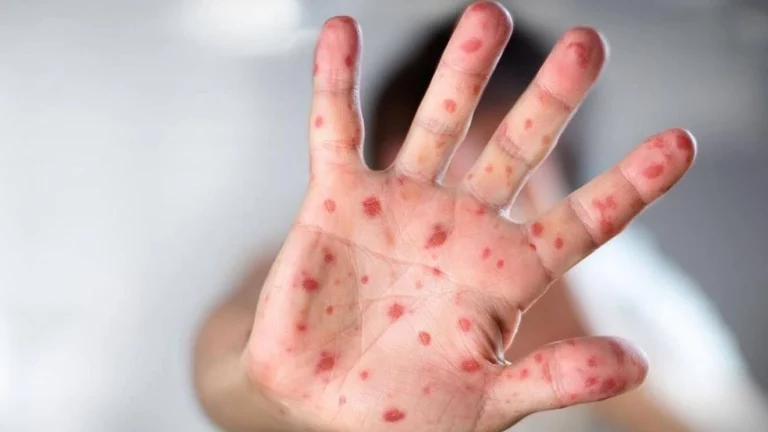 New Clinical Symptoms of Monkeypox