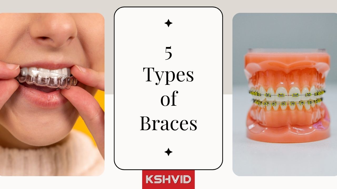 5 Types of Braces - Pros and Cons, Brands, and Cost