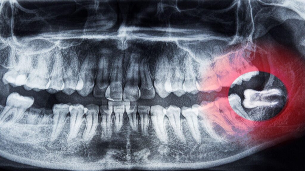 Can Wisdom Teeth Cause Headaches