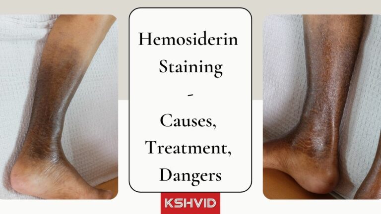 Hemosiderin Staining: Causes, Treatment, & Potential Dangers