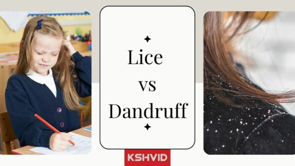 Lice vs Dandruff: Signs, symptoms, causes, treatment - kshvid