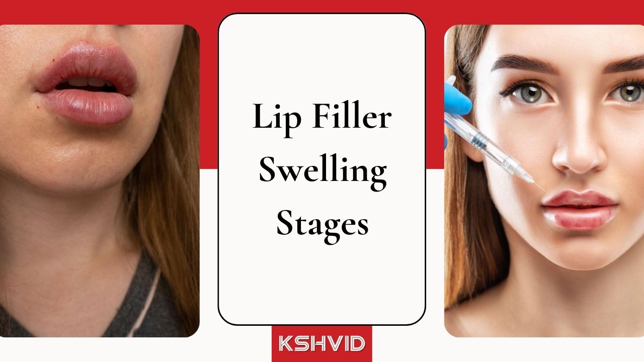 Lip Filler Swelling Stages: Explore 6 Swelling Reduction Tips