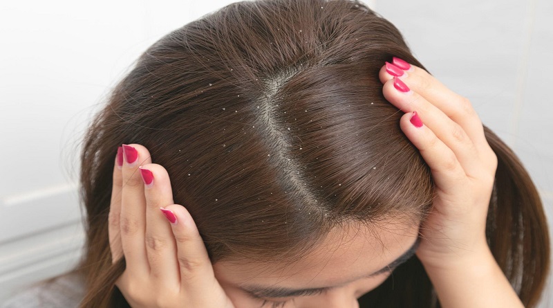 Lice vs dandruff Differences, pictures, and symptoms.jpg