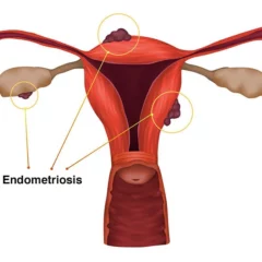 Researchers Find New Treatment For Endometriosis