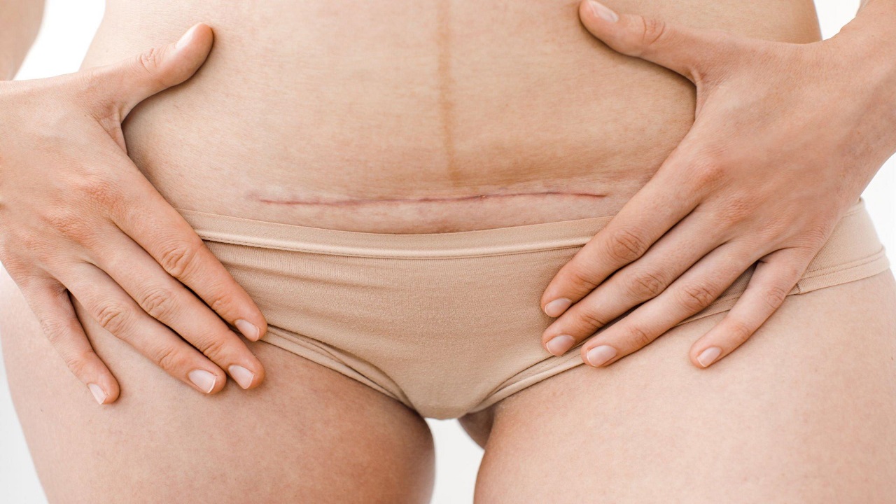 5 Ways to Keep C-section Incision Dry When Overweight