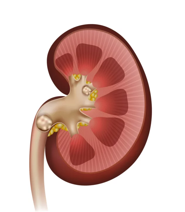 Dietary Factors for Kidney Stones