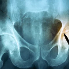 Study: Osteoporotic Hip Fracture A Risky Issue For Elderly Men & Women Globally