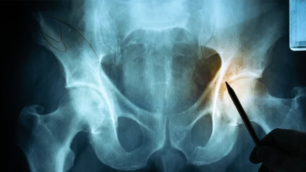 Major Osteoporotic Fracture Risk