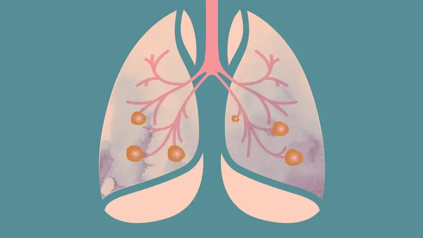 Researchers Finds Drug Resistance To Fight Lung Cancer